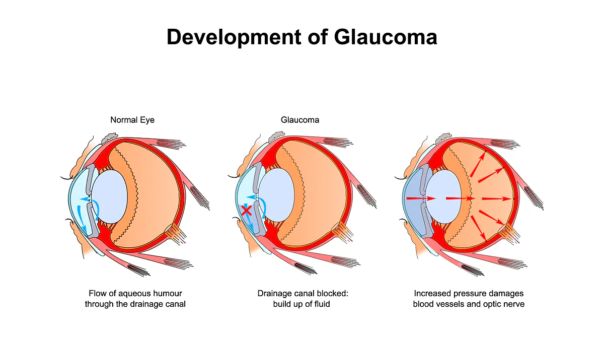 Diagram of glaucoma developing in three stages: in a normal eye aqueous humour flows out through the drainage canal; in glaucoma the canal is blocked and fluid builds up; the increased pressure then damages blood vessels and the optic nerve